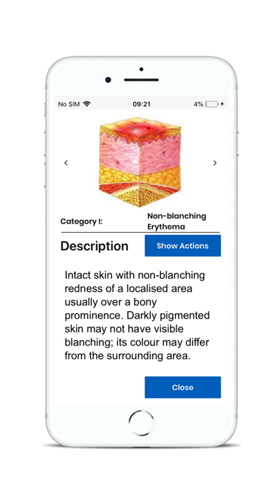 BCG Pressure Ulcer Guide screenshot 2