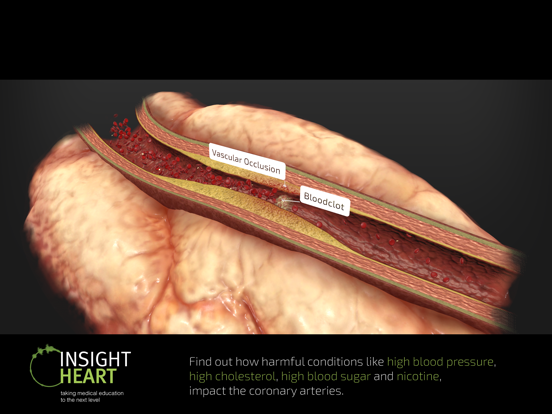 INSIGHT HEART screenshot 2