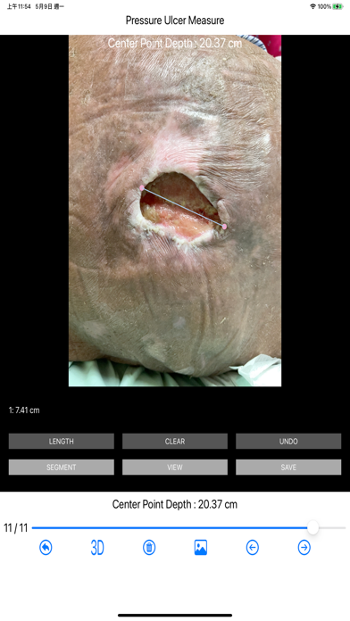 Pressure Ulcer Measure screenshot 3